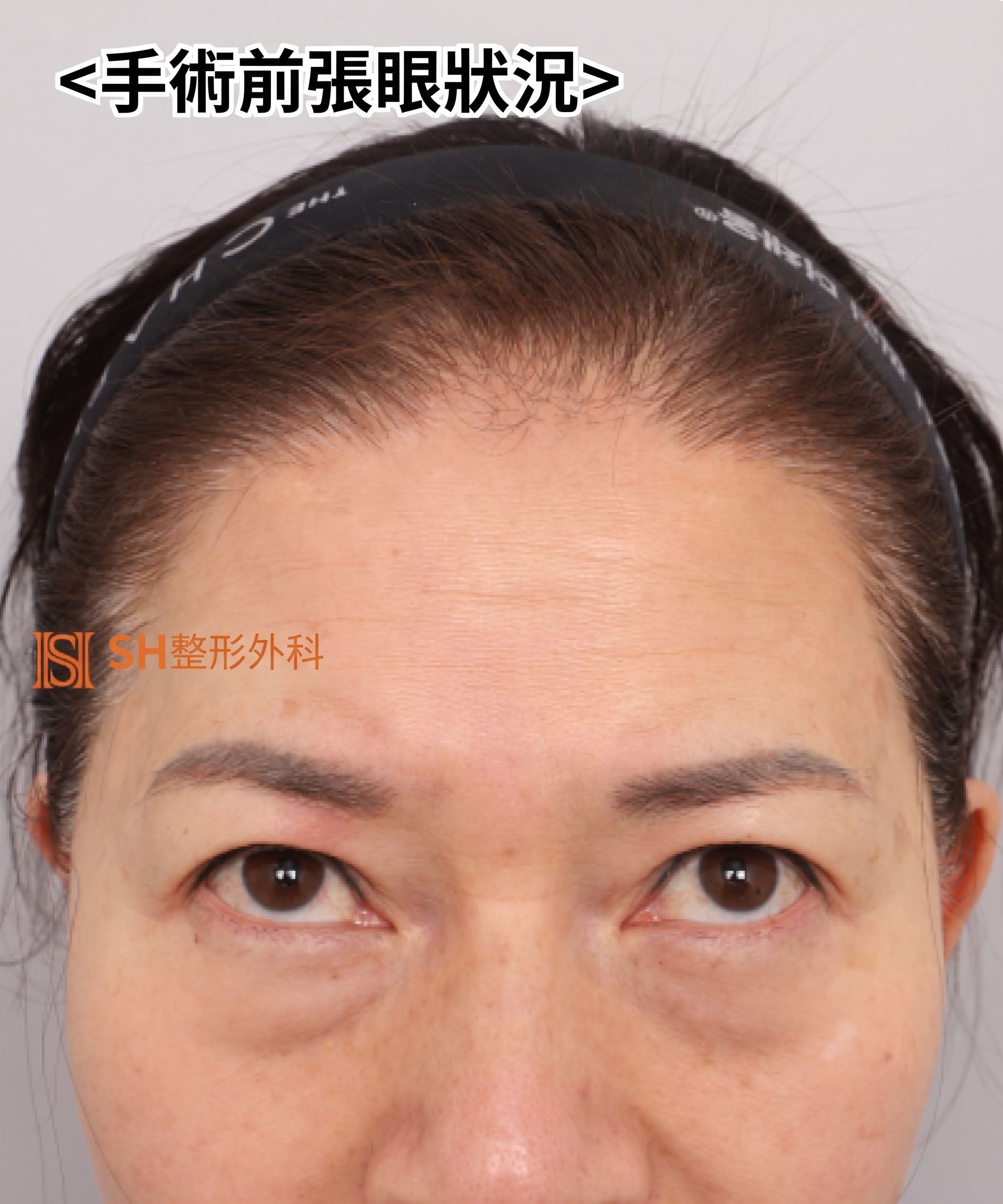 51歲眼皮下垂,為何選擇內視鏡五爪釘提眉術而非切開式雙眼皮? | 眉下提拉·下眼瞼複合手術案例 SH整形外科 사진 12