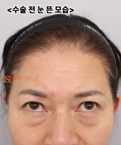 51세 눈처짐, 절개쌍꺼풀 대신 엔도타인 이마거상으로 해결한 이유 | 눈썹하거상·하안검 복합수술 케이스 SH성형외과 에스에이치성형외과 사진 12