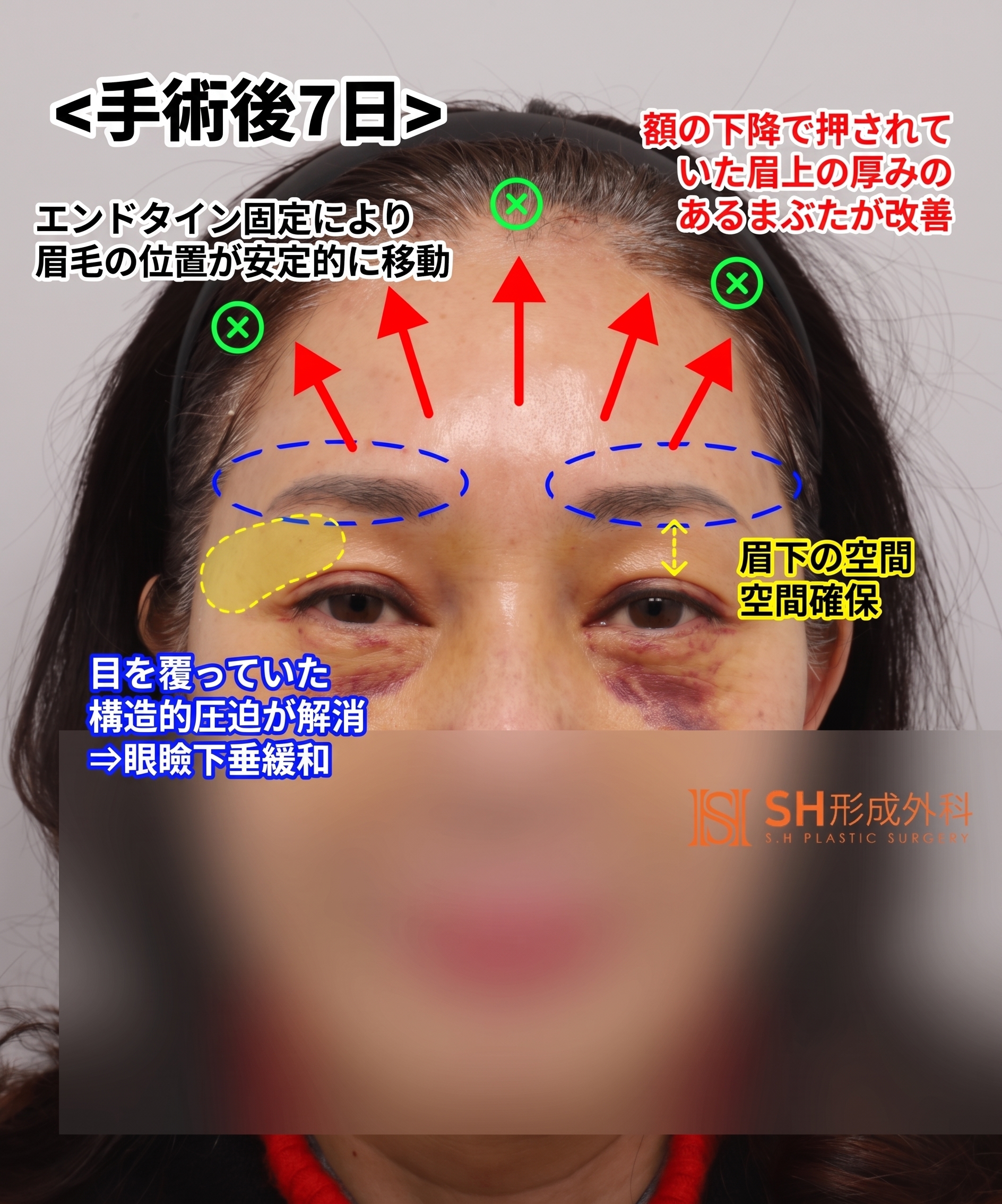 51歳目のたるみ、切開二重ではなくエンドタイン額挙上で解決した理由 | 眉下切開・下眼瞼複合手術ケース SH美容外科 エスエイチ美容外科 사진 6