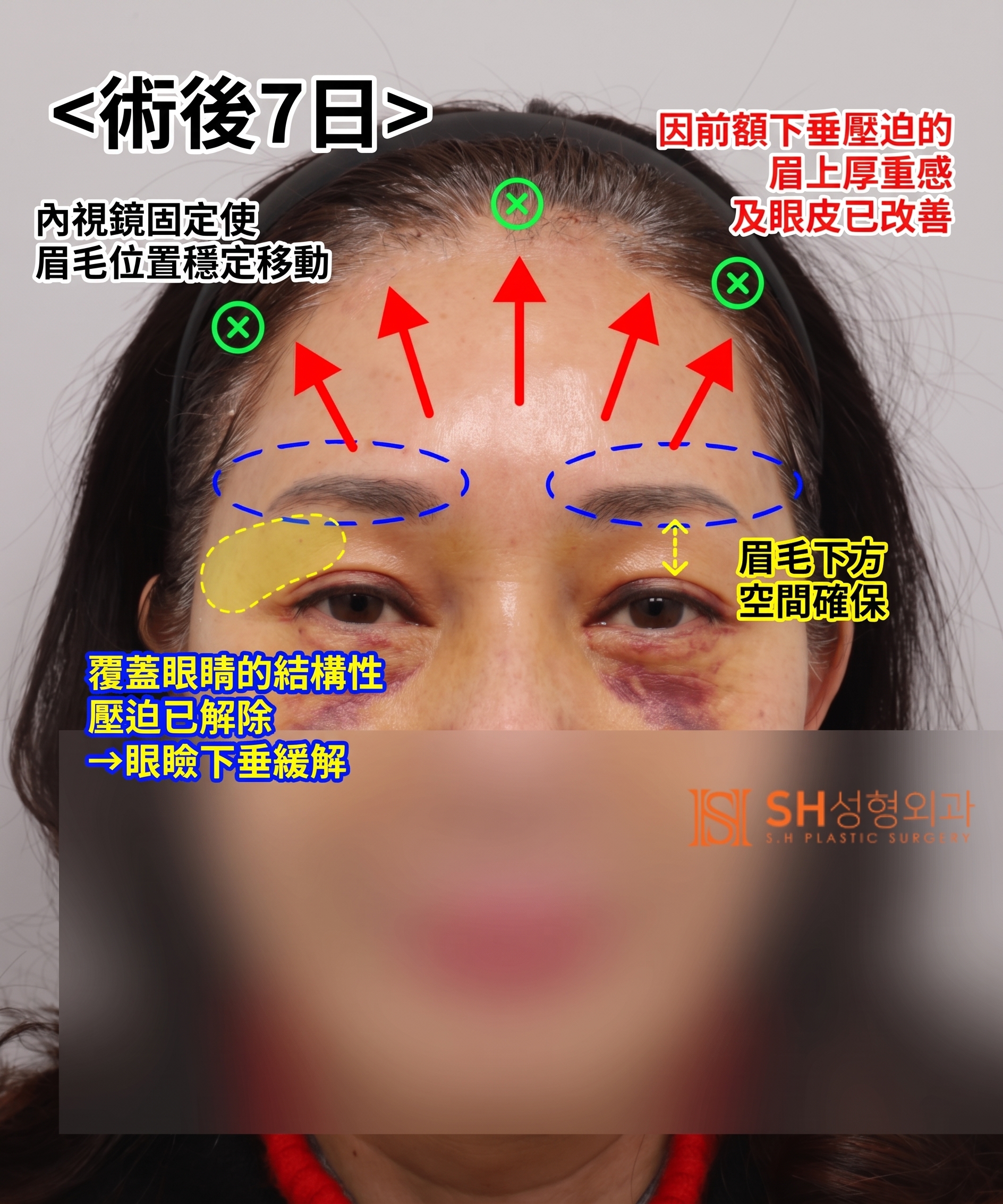 51歲眼皮下垂,為何選擇內視鏡五爪釘提眉術而非切開式雙眼皮? | 眉下提拉·下眼瞼複合手術案例 SH整形外科 사진 6
