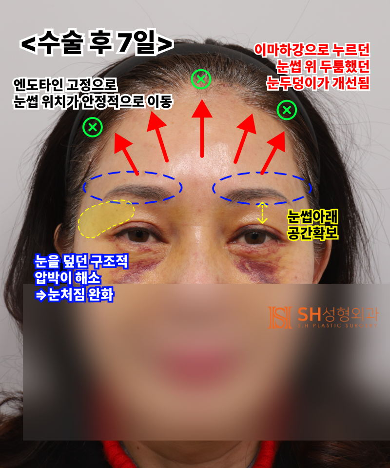 51세 눈처짐, 절개쌍꺼풀 대신 엔도타인 이마거상으로 해결한 이유 | 눈썹하거상·하안검 복합수술 케이스 SH성형외과 에스에이치성형외과 사진 6