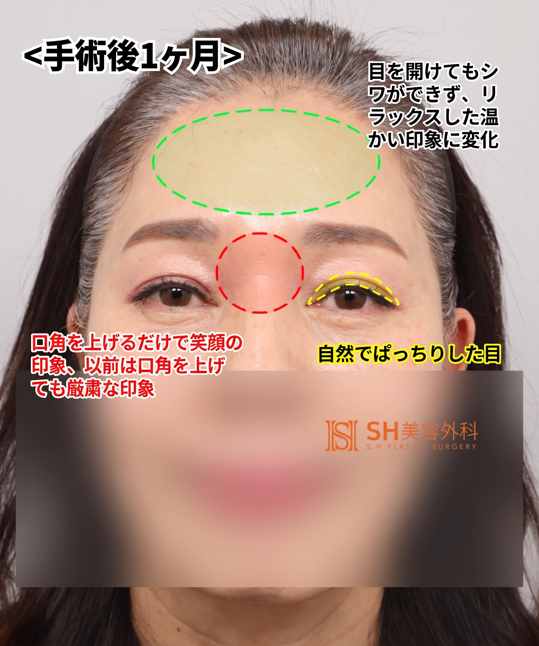 51歳目のたるみ、切開二重ではなくエンドタイン額挙上で解決した理由 | 眉下切開・下眼瞼複合手術ケース SH美容外科 エスエイチ美容外科 사진 8