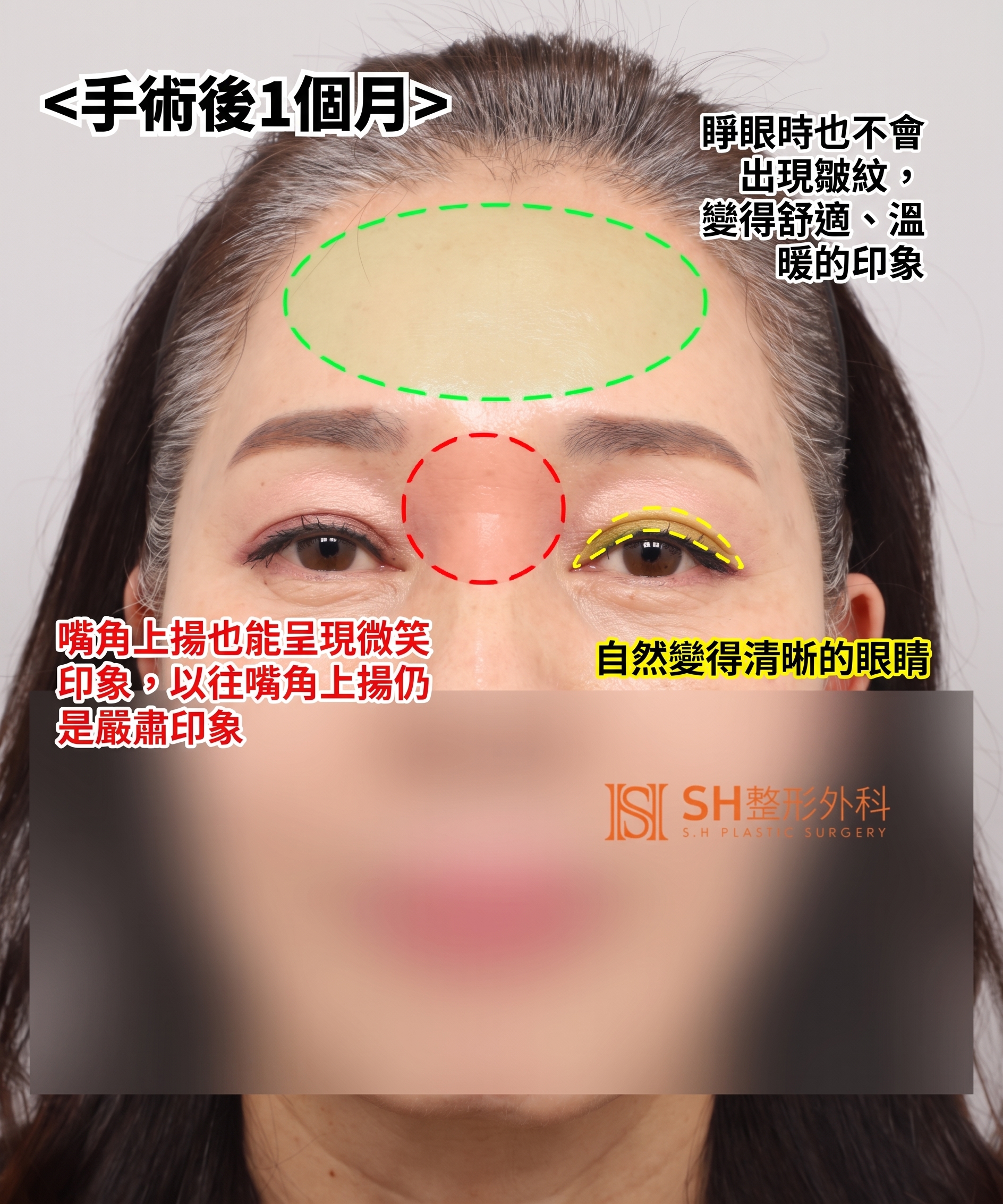 51歲眼皮下垂,為何選擇內視鏡五爪釘提眉術而非切開式雙眼皮? | 眉下提拉·下眼瞼複合手術案例 SH整形外科 사진 8