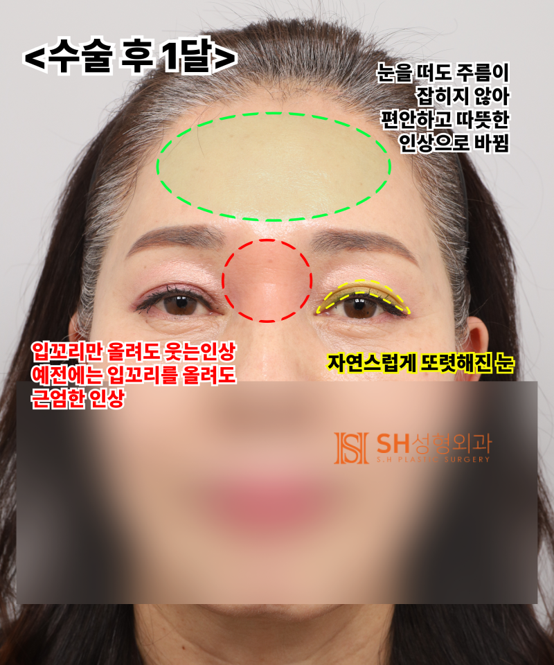 51세 눈처짐, 절개쌍꺼풀 대신 엔도타인 이마거상으로 해결한 이유 | 눈썹하거상·하안검 복합수술 케이스 SH성형외과 에스에이치성형외과 사진 8