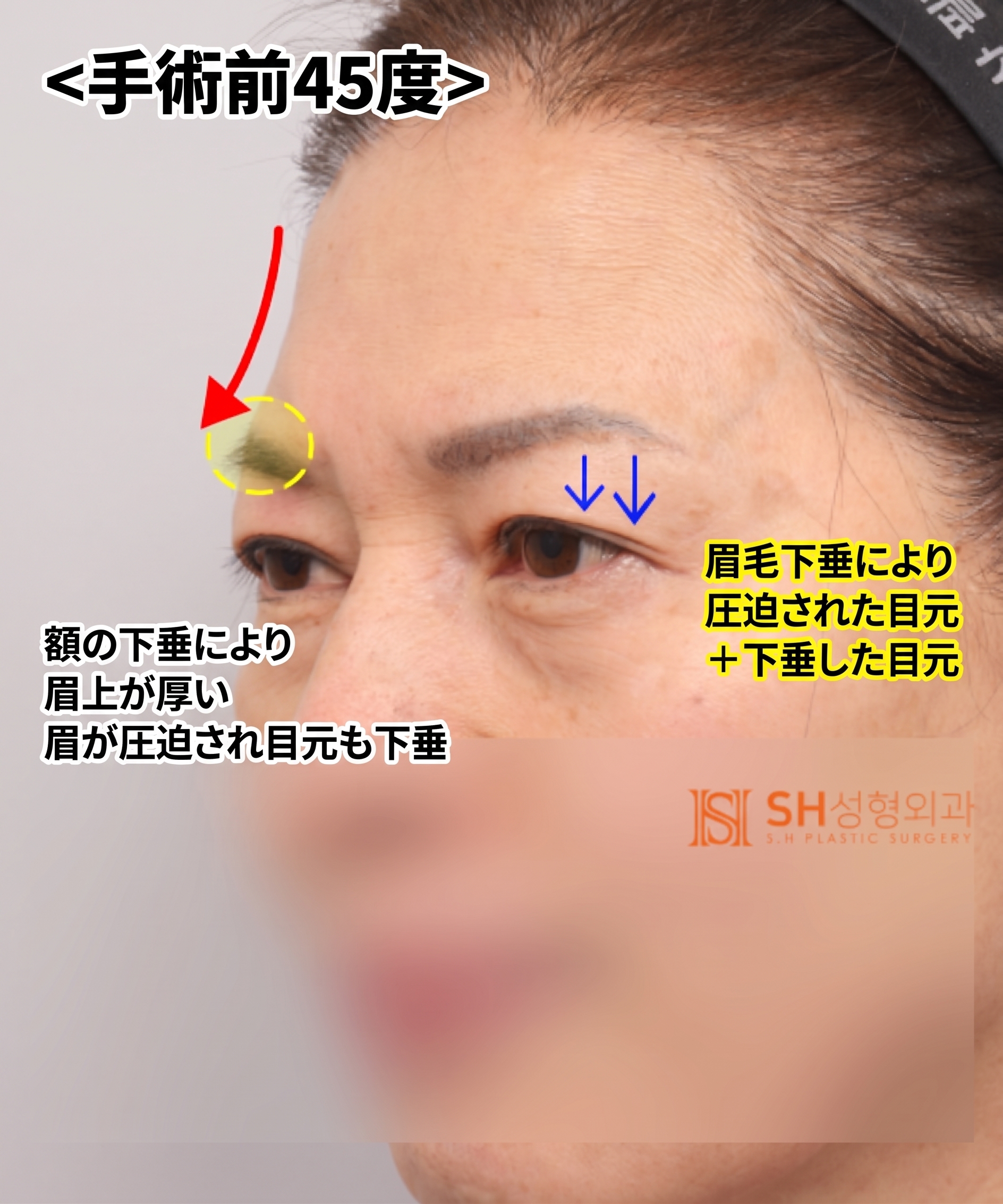 51歳目のたるみ、切開二重ではなくエンドタイン額挙上で解決した理由 | 眉下切開・下眼瞼複合手術ケース SH美容外科 エスエイチ美容外科 사진 14