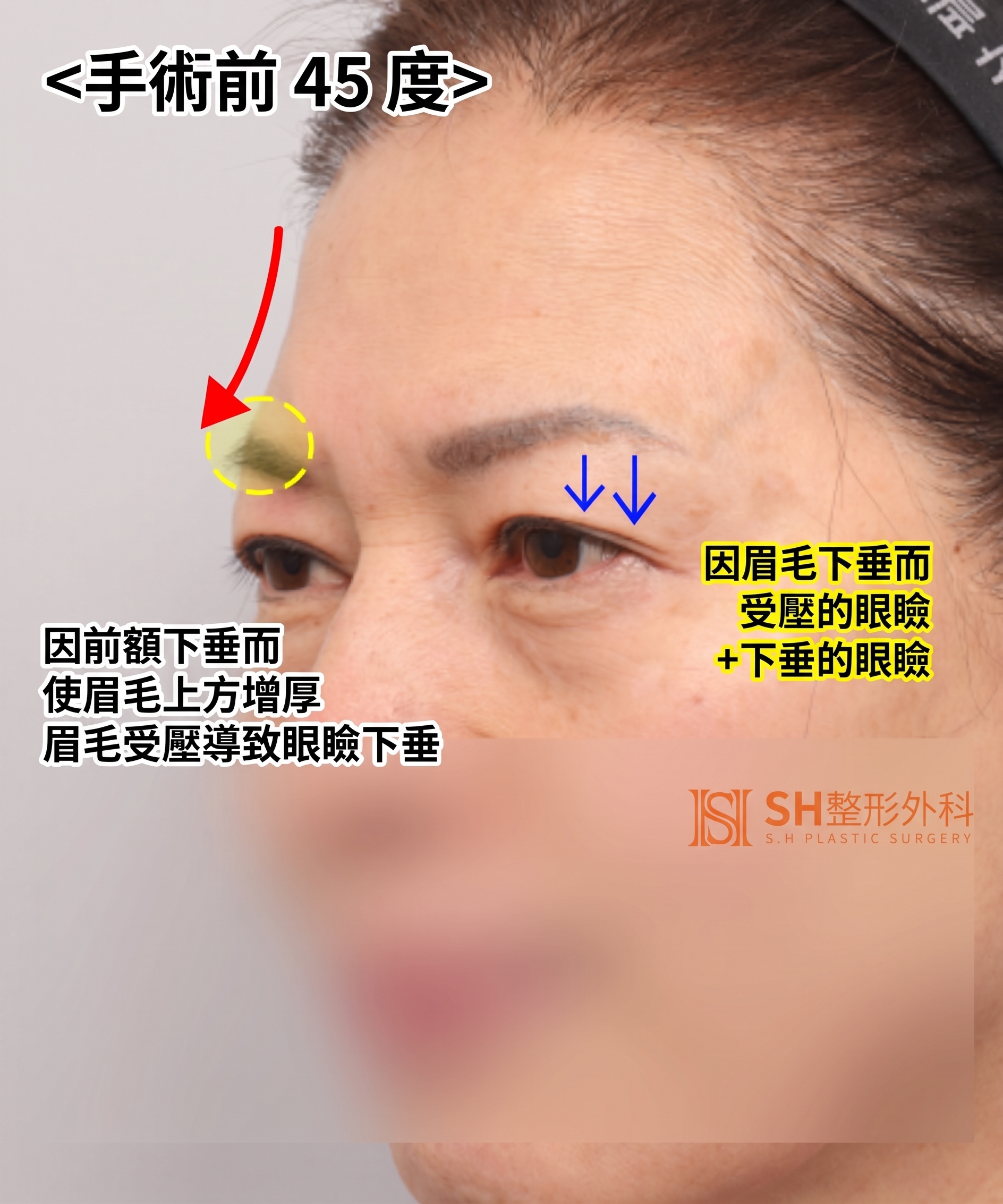51歲眼皮下垂,為何選擇內視鏡五爪釘提眉術而非切開式雙眼皮? | 眉下提拉·下眼瞼複合手術案例 SH整形外科 사진 14