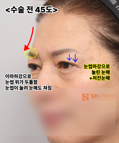 51세 눈처짐, 절개쌍꺼풀 대신 엔도타인 이마거상으로 해결한 이유 | 눈썹하거상·하안검 복합수술 케이스 SH성형외과 에스에이치성형외과 사진 14