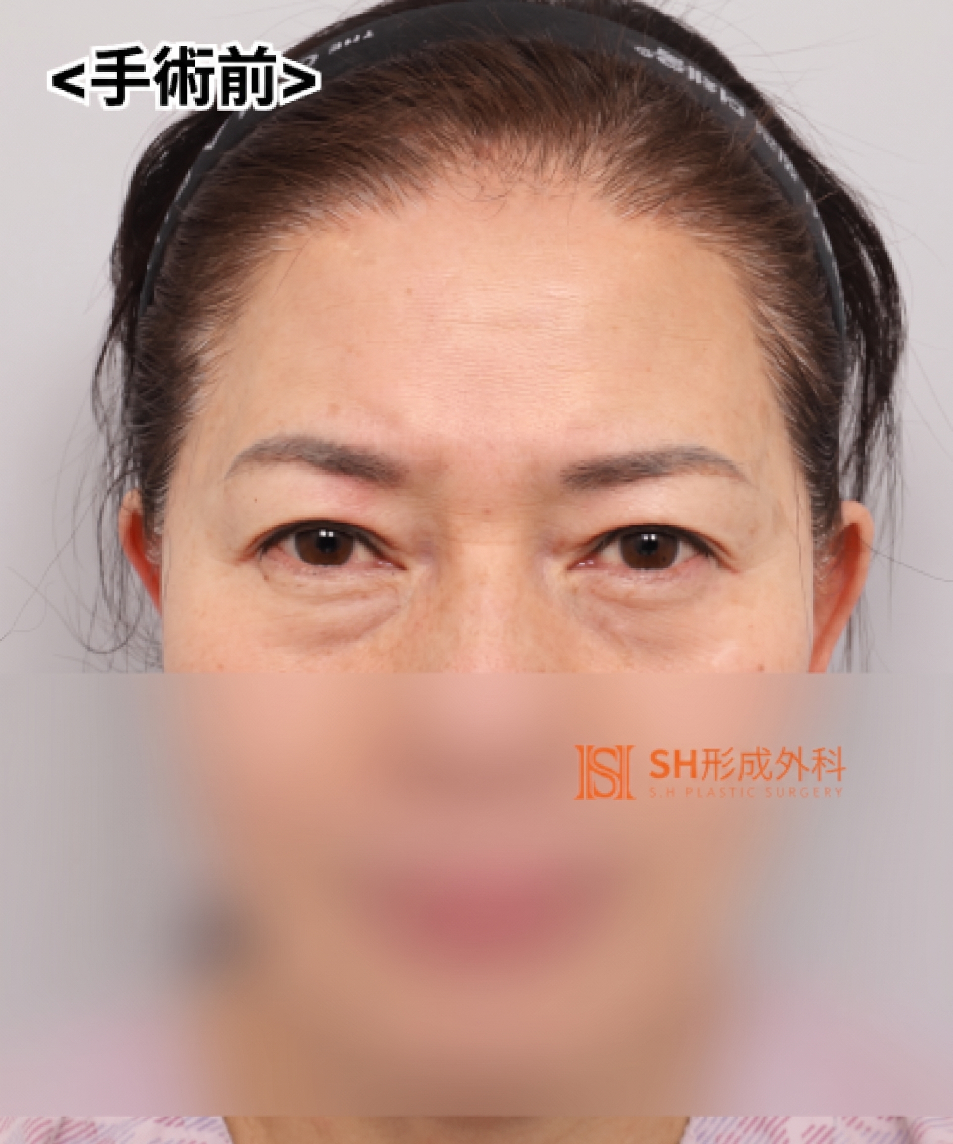 51歳目のたるみ、切開二重ではなくエンドタイン額挙上で解決した理由 | 眉下切開・下眼瞼複合手術ケース SH美容外科 エスエイチ美容外科