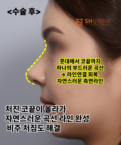콧볼축소를 원하셨지만, 하면 안 됐던 코! 코끝이 먼저였던 이유 sh성형외과 에스에이치성형외과 사진 12
