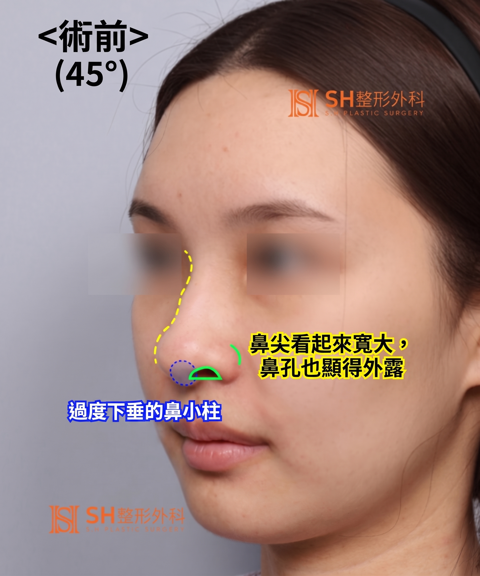 想縮鼻翼卻不適合?鼻尖才是關鍵的原因!SH整形外科 사진 7