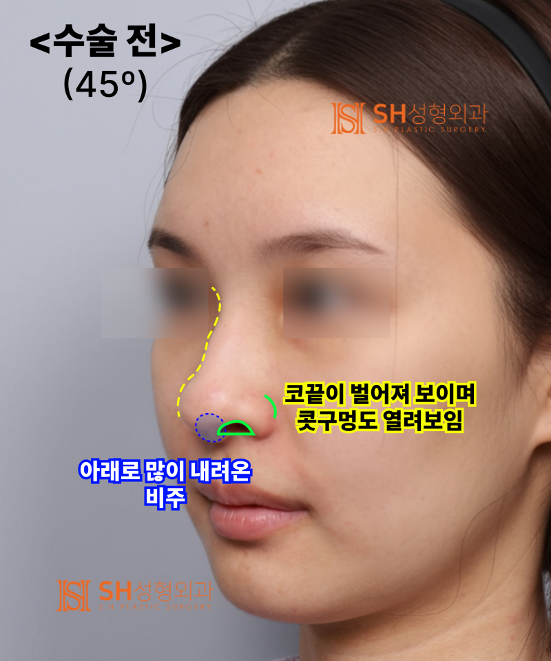 콧볼축소를 원하셨지만, 하면 안 됐던 코! 코끝이 먼저였던 이유 sh성형외과 에스에이치성형외과 사진 7