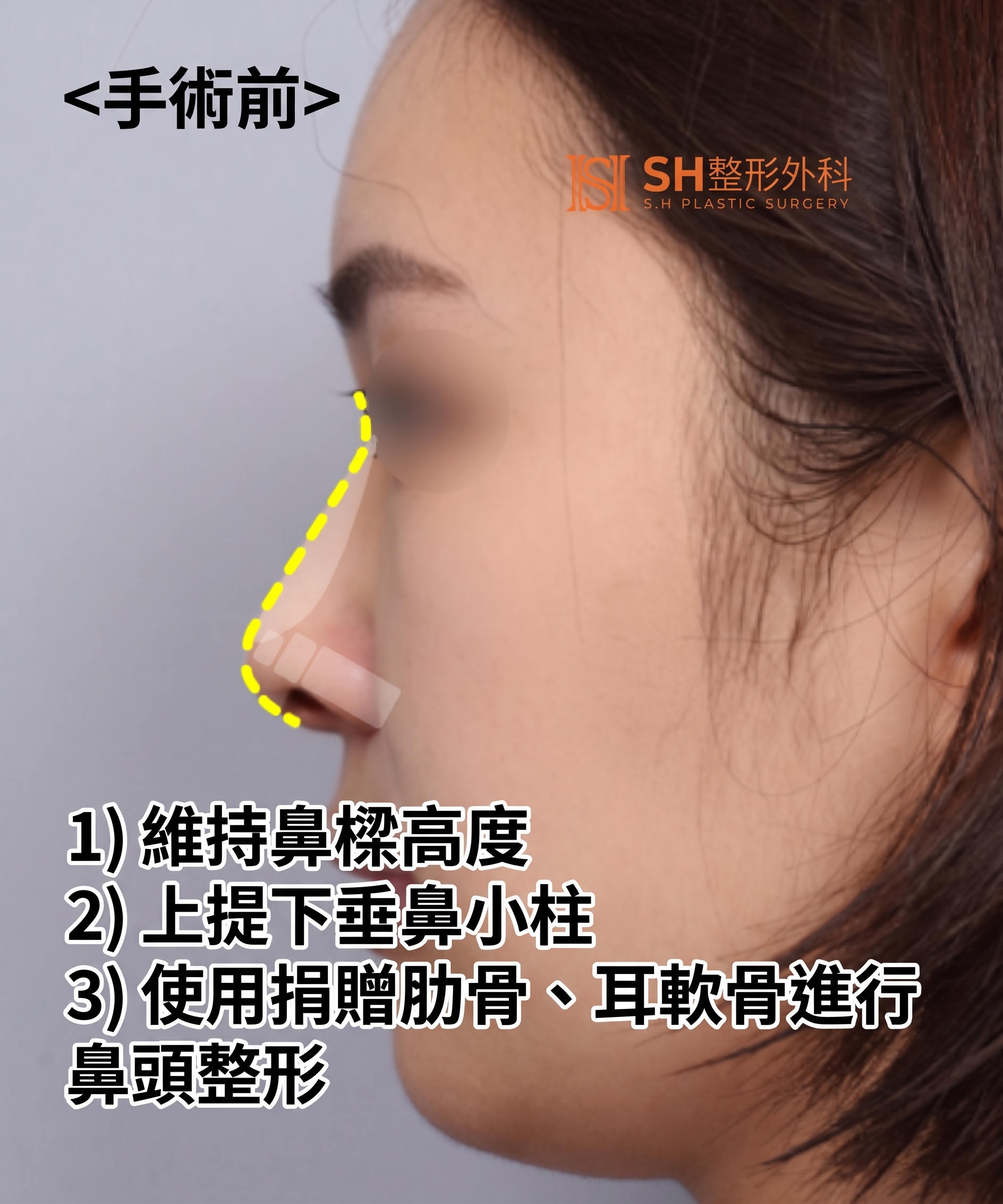 想縮鼻翼卻不適合?鼻尖才是關鍵的原因!SH整形外科 사진 28