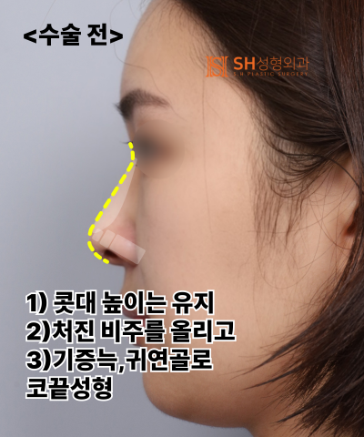 콧볼축소를 원하셨지만, 하면 안 됐던 코! 코끝이 먼저였던 이유 sh성형외과 에스에이치성형외과 사진 28
