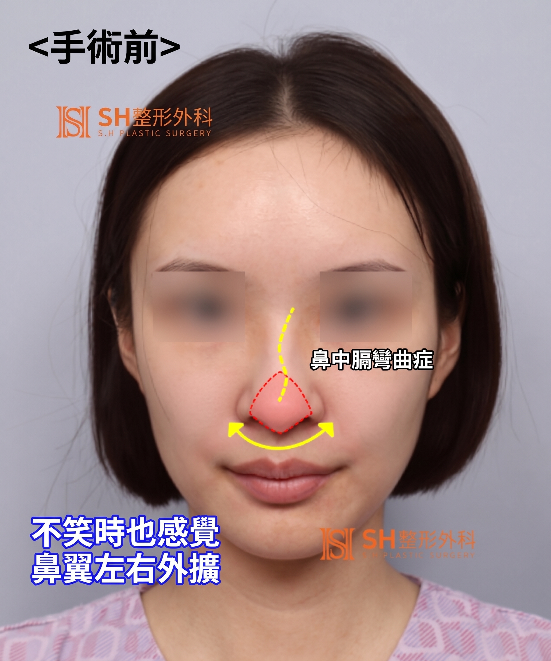 想縮鼻翼卻不適合?鼻尖才是關鍵的原因!SH整形外科 사진 8