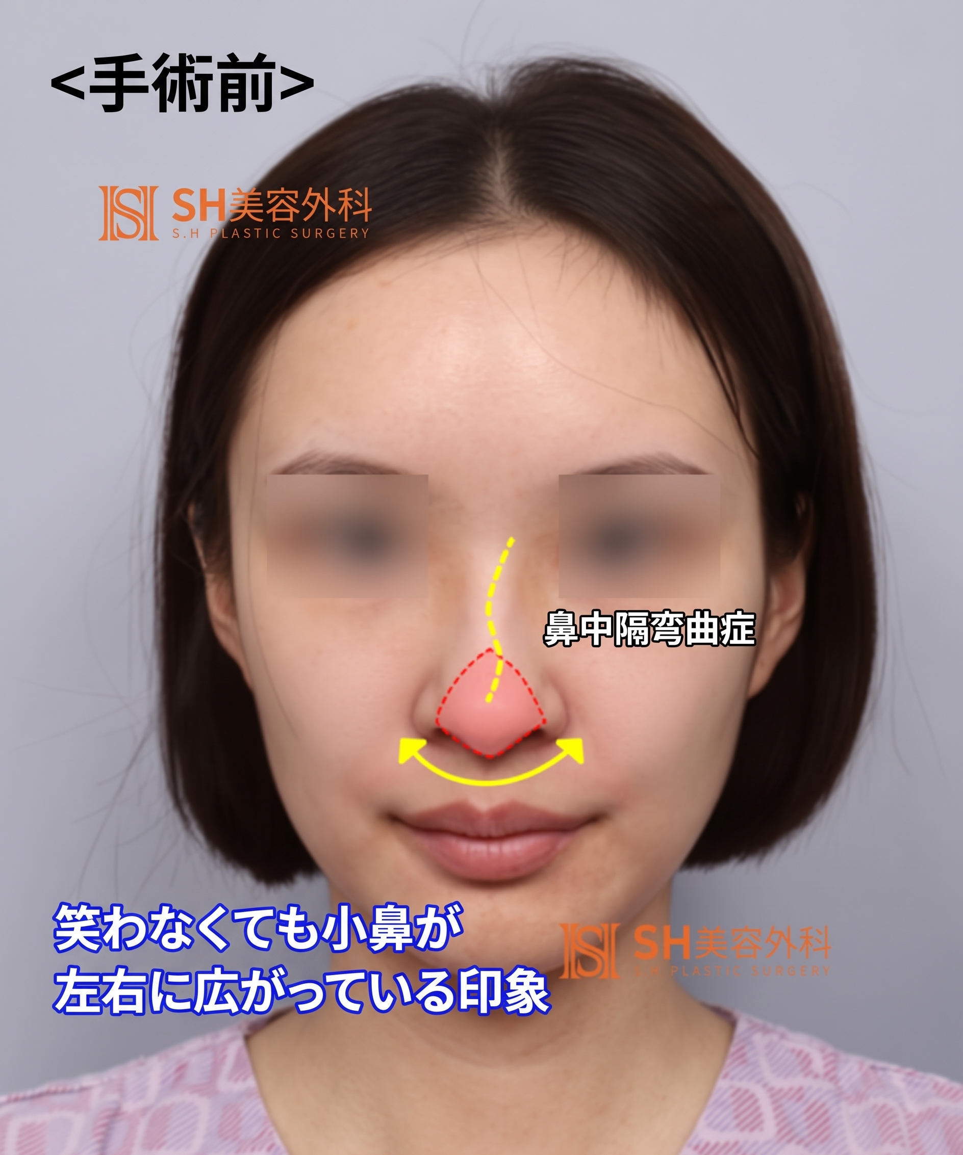 小鼻縮小を希望されたが、してはいけなかった鼻！鼻先が先だった理由 sh美容外科 SH美容外科 사진 16