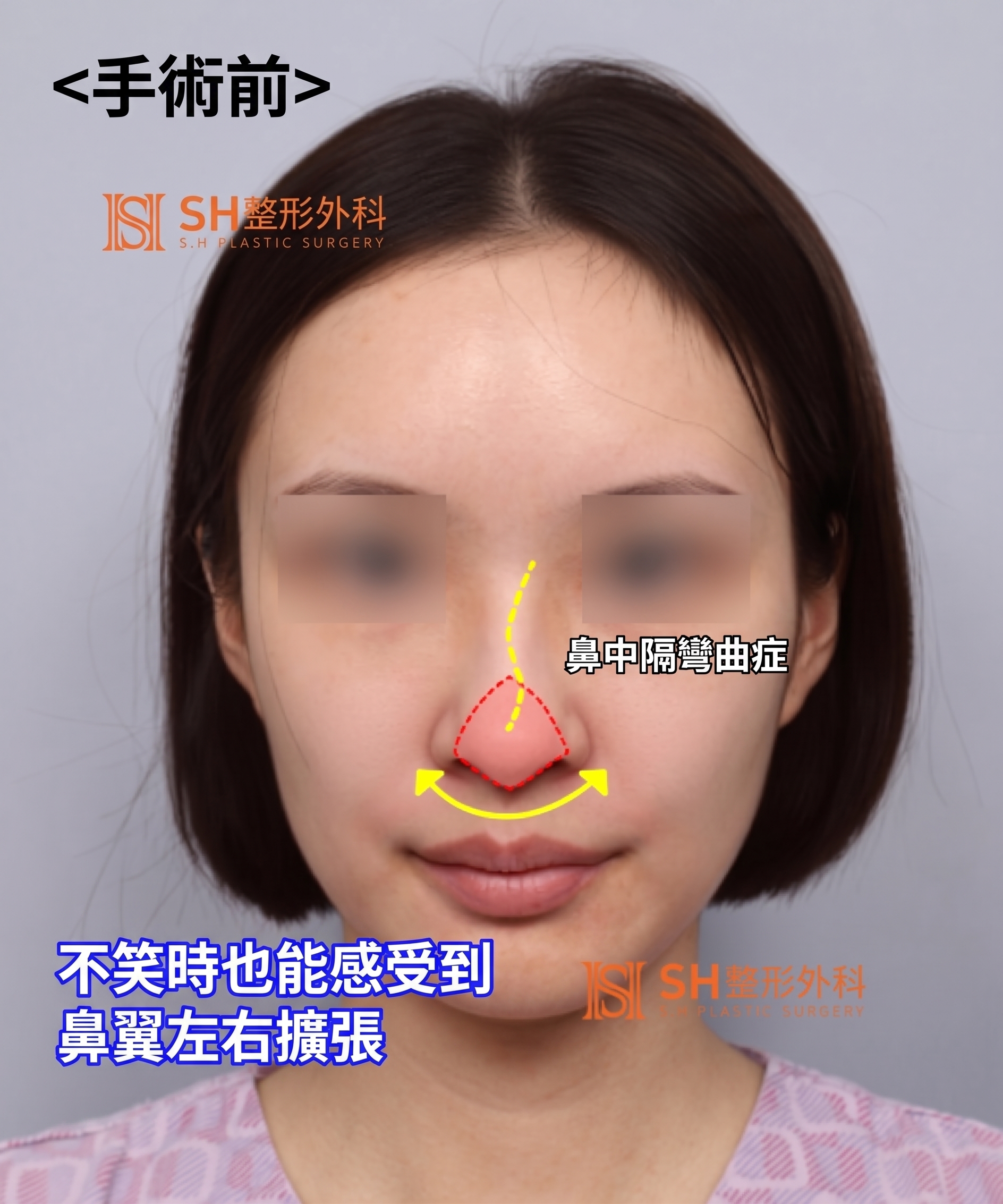 想縮鼻翼卻不適合?鼻尖才是關鍵的原因!SH整形外科 사진 16