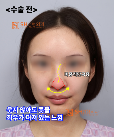 콧볼축소를 원하셨지만, 하면 안 됐던 코! 코끝이 먼저였던 이유 sh성형외과 에스에이치성형외과 사진 16