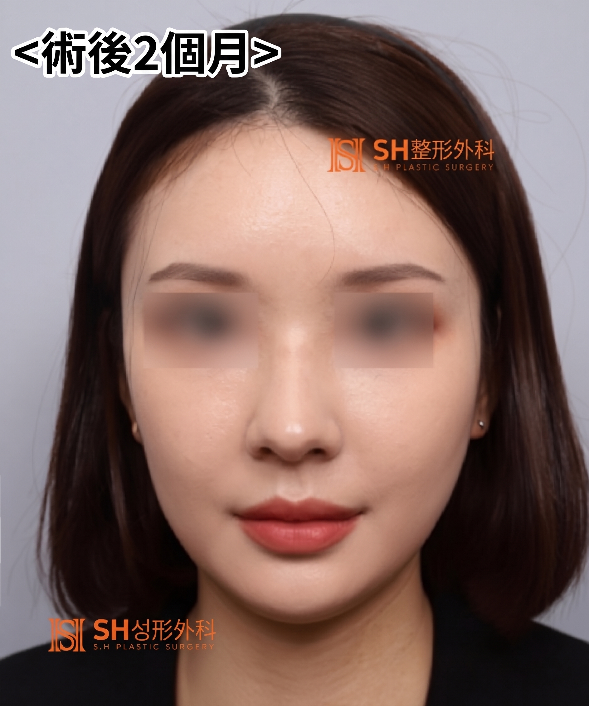想縮鼻翼卻不適合?鼻尖才是關鍵的原因!SH整形外科 사진 2