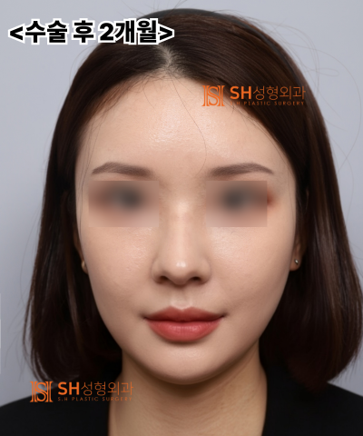 콧볼축소를 원하셨지만, 하면 안 됐던 코! 코끝이 먼저였던 이유 sh성형외과 에스에이치성형외과 사진 2