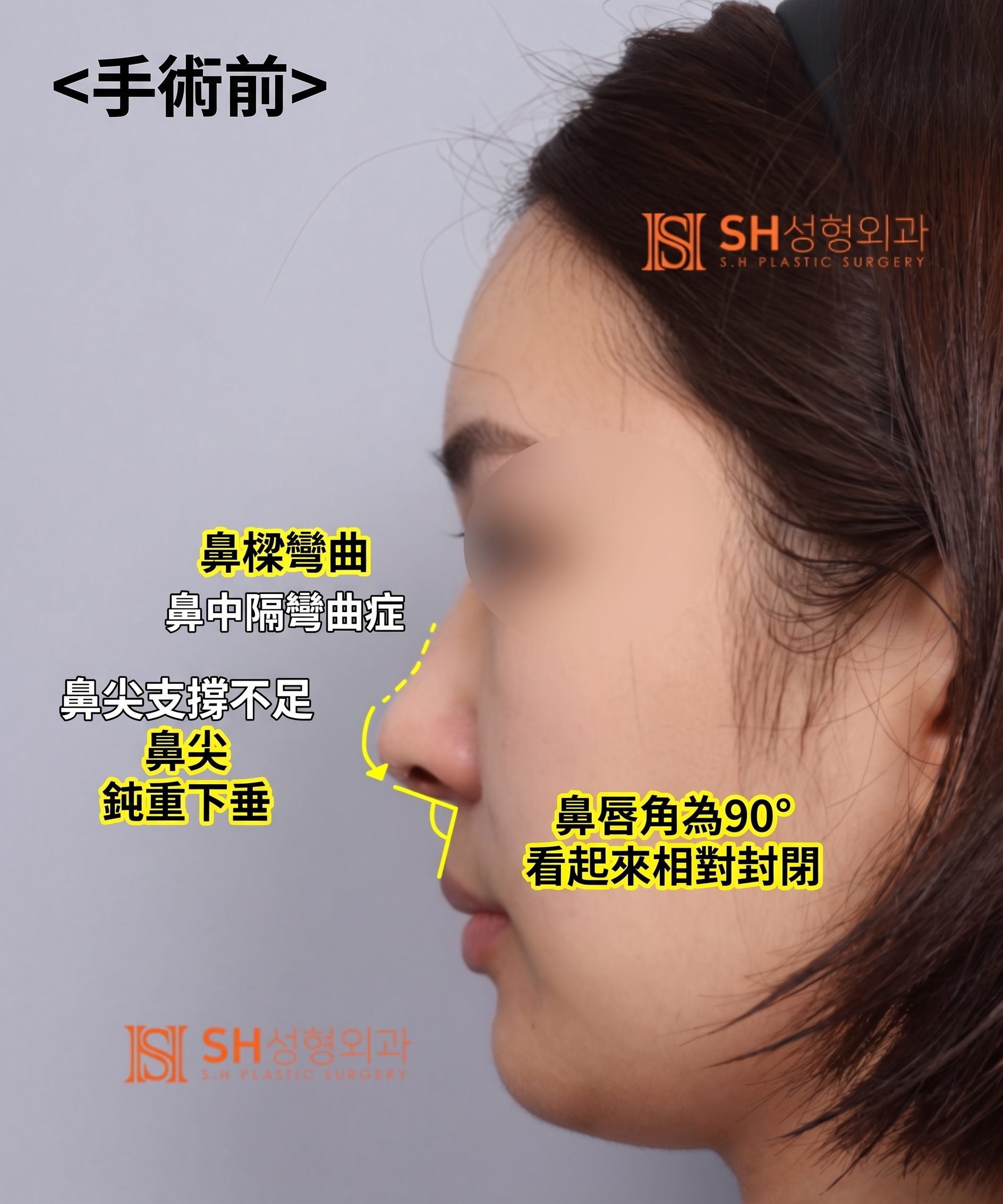 想縮鼻翼卻不適合?鼻尖才是關鍵的原因!SH整形外科 사진 6