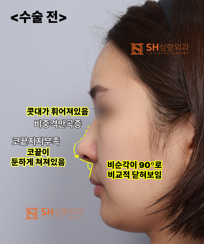 콧볼축소를 원하셨지만, 하면 안 됐던 코! 코끝이 먼저였던 이유 sh성형외과 에스에이치성형외과 사진 6