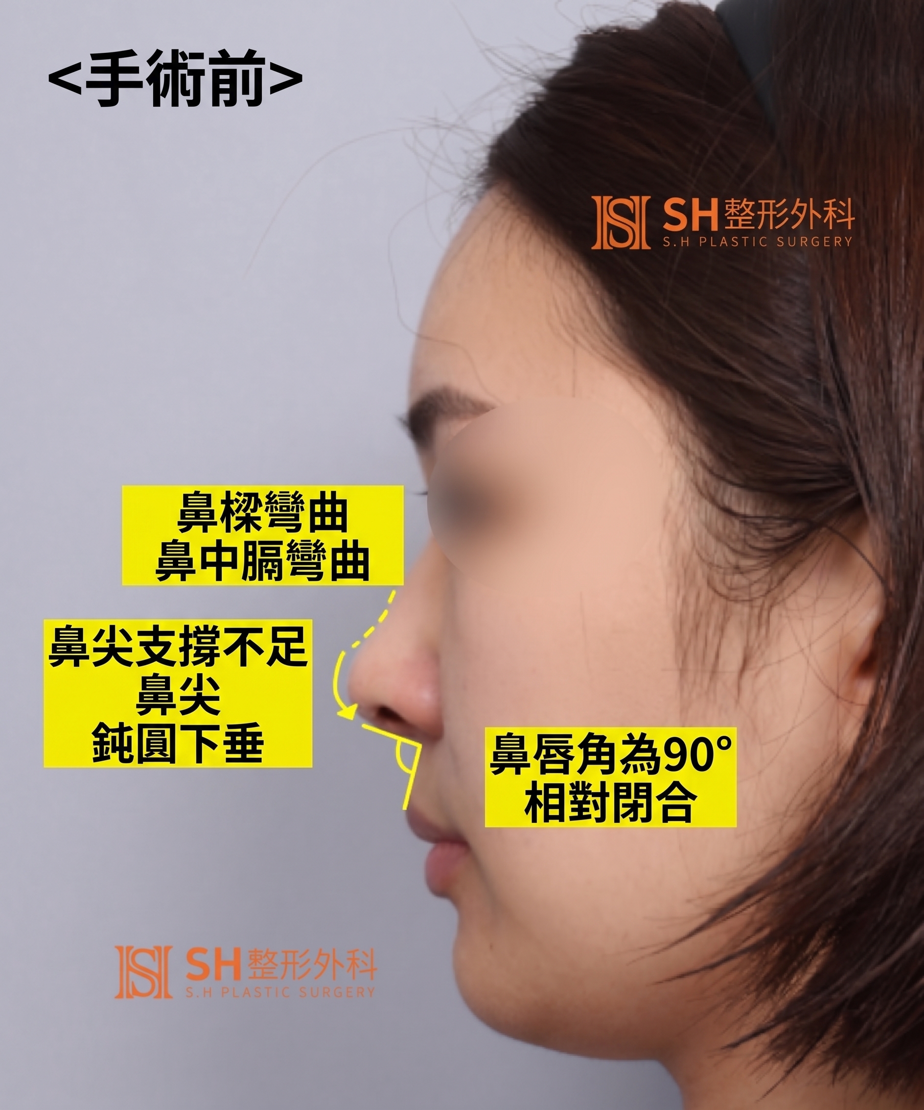 想縮鼻翼卻不適合?鼻尖才是關鍵的原因!SH整形外科 사진 23