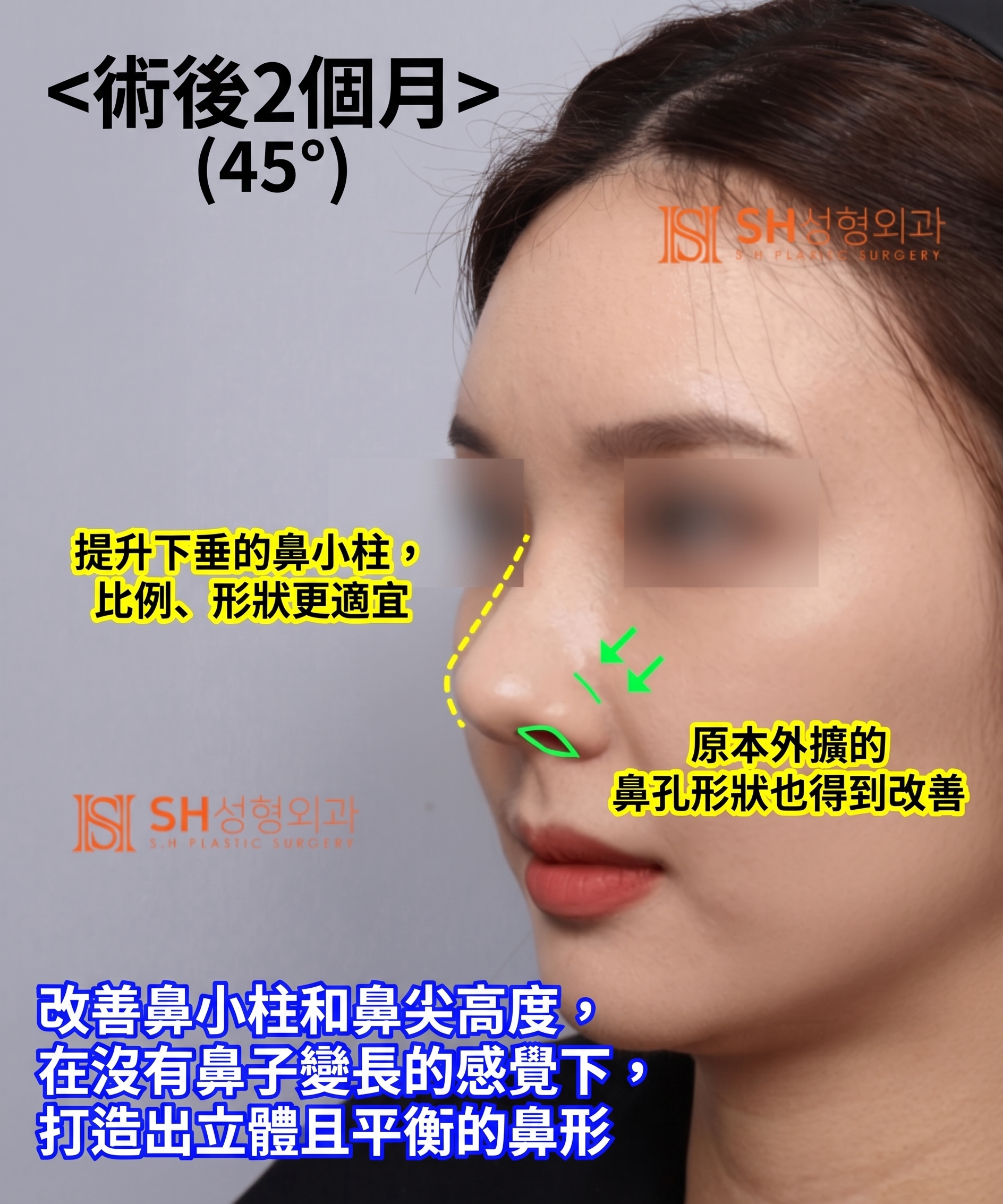 想縮鼻翼卻不適合?鼻尖才是關鍵的原因!SH整形外科 사진 15