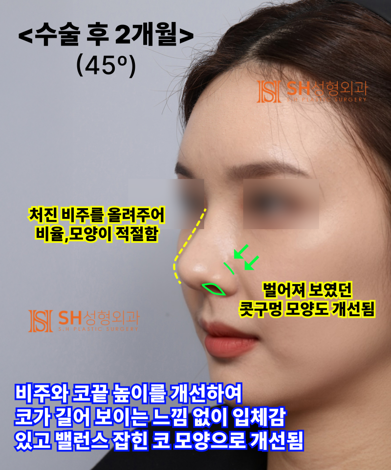 콧볼축소를 원하셨지만, 하면 안 됐던 코! 코끝이 먼저였던 이유 sh성형외과 에스에이치성형외과 사진 15