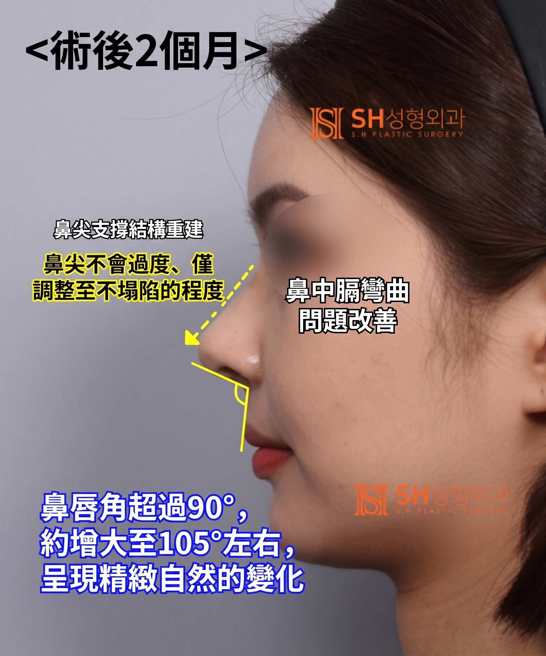 想縮鼻翼卻不適合?鼻尖才是關鍵的原因!SH整形外科 사진 14