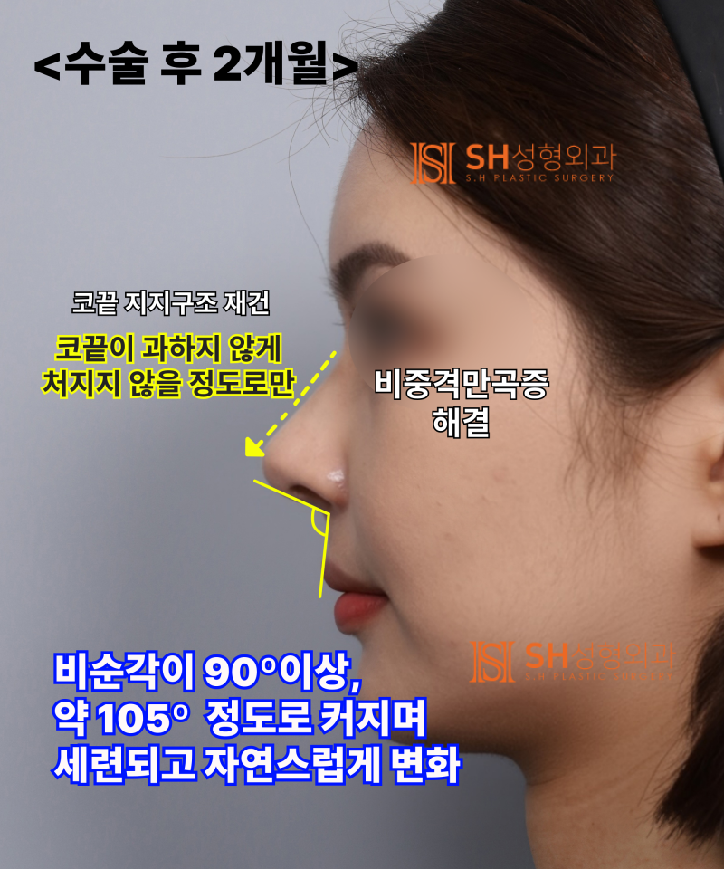 콧볼축소를 원하셨지만, 하면 안 됐던 코! 코끝이 먼저였던 이유 sh성형외과 에스에이치성형외과 사진 14