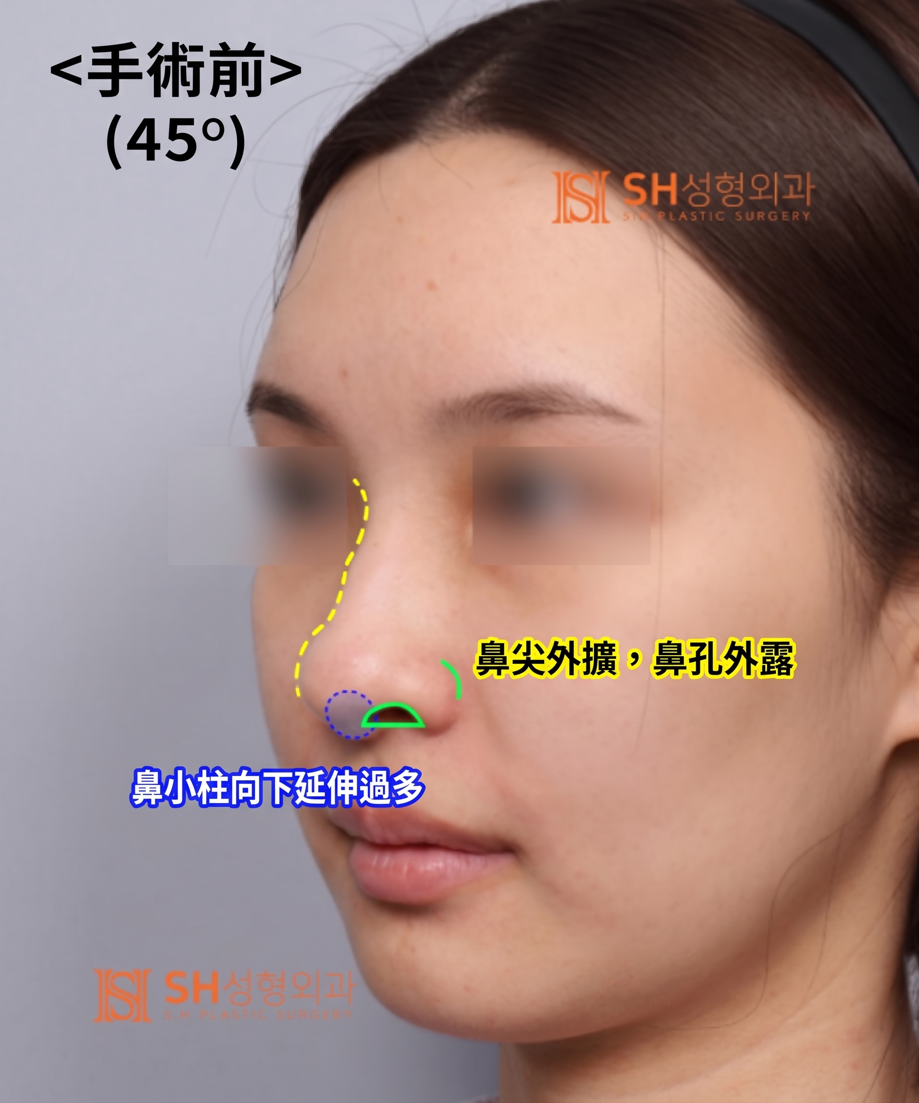 想縮鼻翼卻不適合?鼻尖才是關鍵的原因!SH整形外科 사진 24