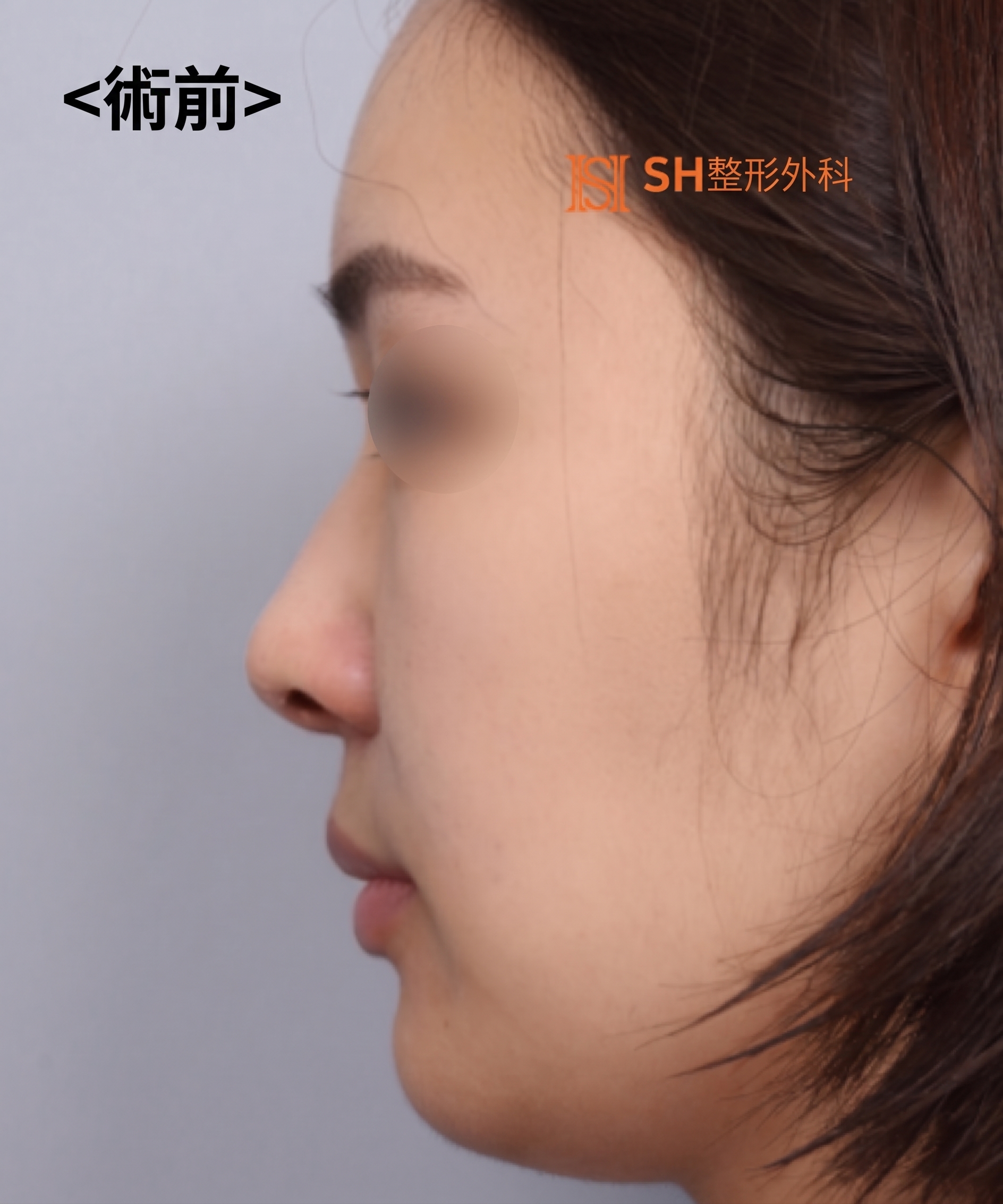 想縮鼻翼卻不適合?鼻尖才是關鍵的原因!SH整形外科 사진 32