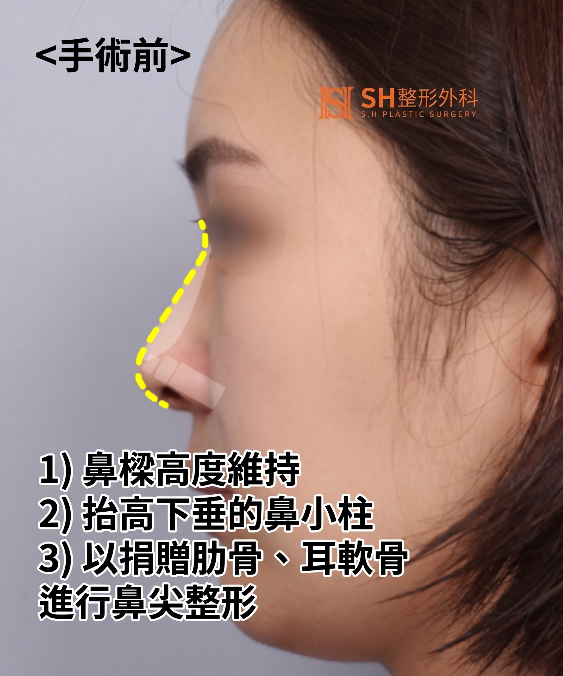 想縮鼻翼卻不適合?鼻尖才是關鍵的原因!SH整形外科 사진 11