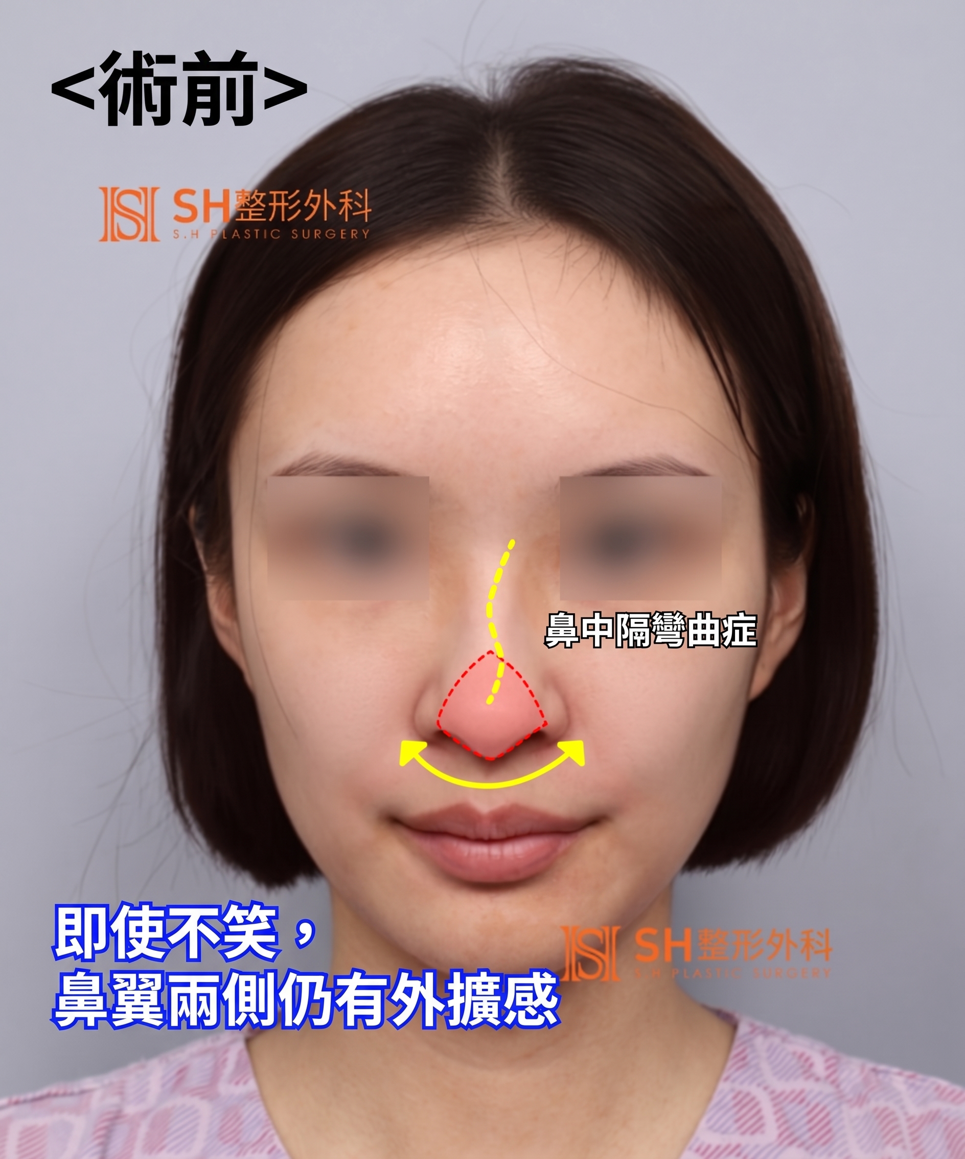 想縮鼻翼卻不適合?鼻尖才是關鍵的原因!SH整形外科 사진 5