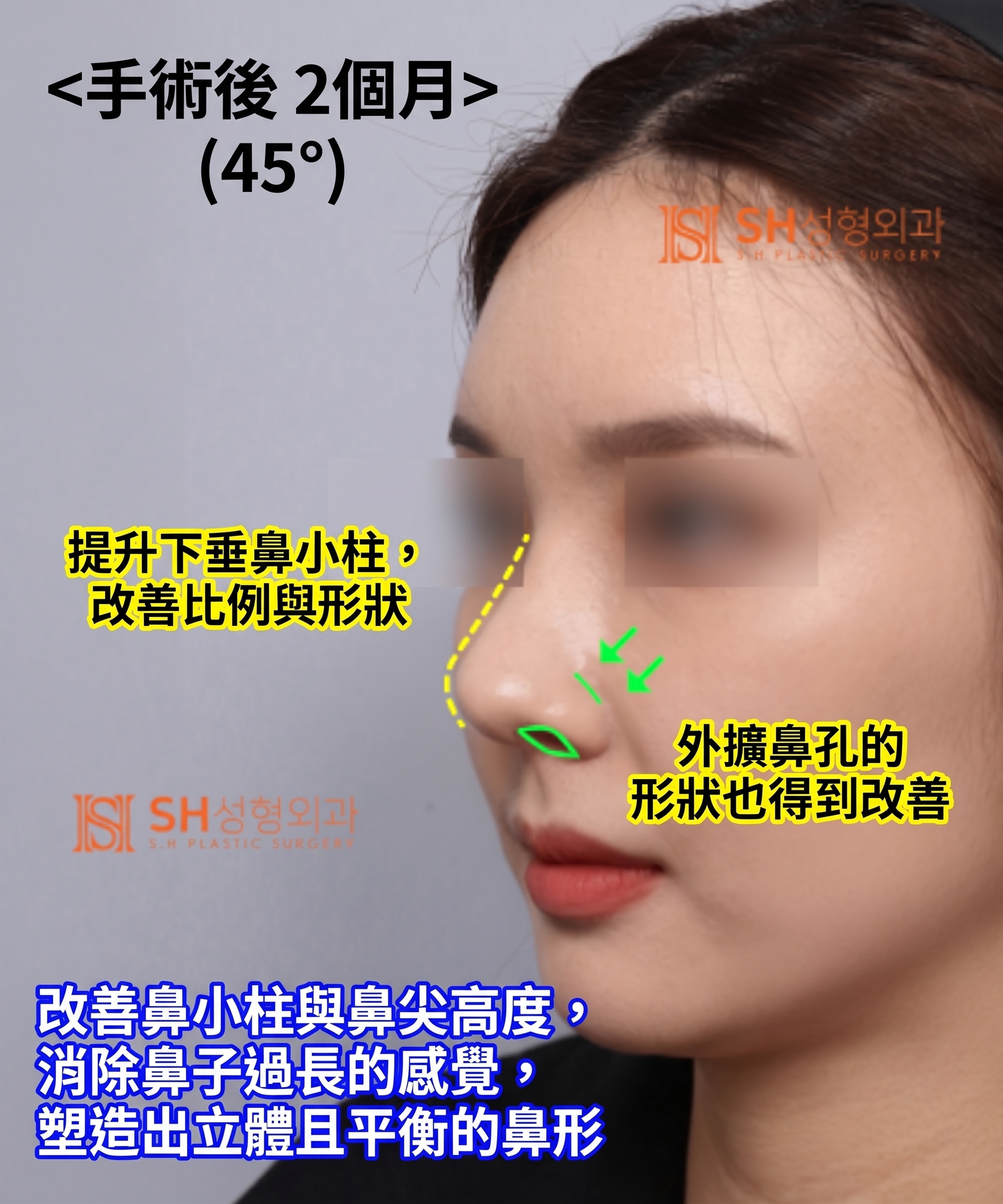 想縮鼻翼卻不適合?鼻尖才是關鍵的原因!SH整形外科 사진 27
