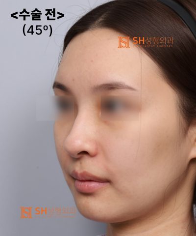 콧볼축소를 원하셨지만, 하면 안 됐던 코! 코끝이 먼저였던 이유 sh성형외과 에스에이치성형외과 사진 34
