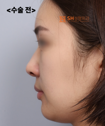 콧볼축소를 원하셨지만, 하면 안 됐던 코! 코끝이 먼저였던 이유 sh성형외과 에스에이치성형외과 사진 3