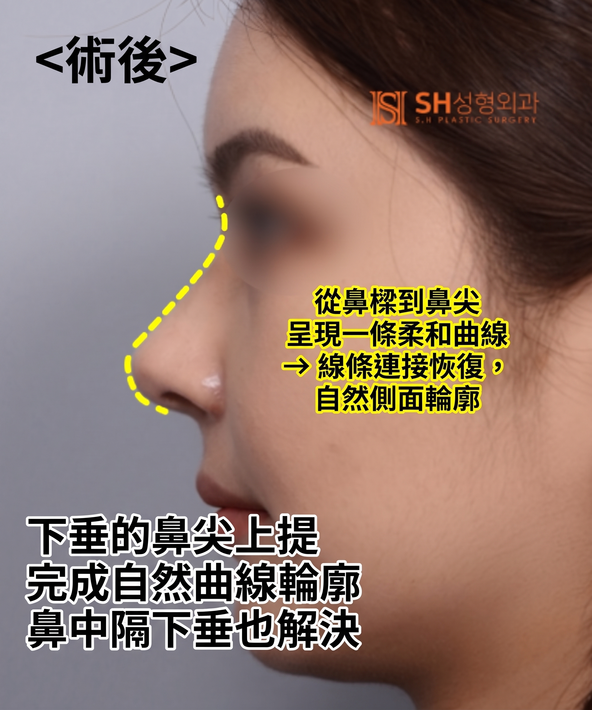 想縮鼻翼卻不適合?鼻尖才是關鍵的原因!SH整形外科 사진 29