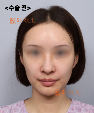 콧볼축소를 원하셨지만, 하면 안 됐던 코! 코끝이 먼저였던 이유 sh성형외과 에스에이치성형외과 사진 30