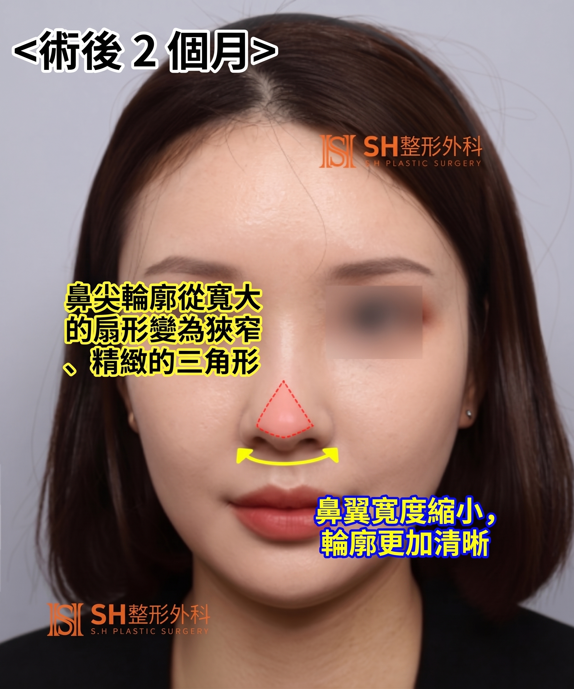 想縮鼻翼卻不適合?鼻尖才是關鍵的原因!SH整形外科 사진 25
