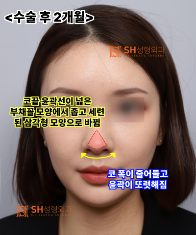 콧볼축소를 원하셨지만, 하면 안 됐던 코! 코끝이 먼저였던 이유 sh성형외과 에스에이치성형외과 사진 25