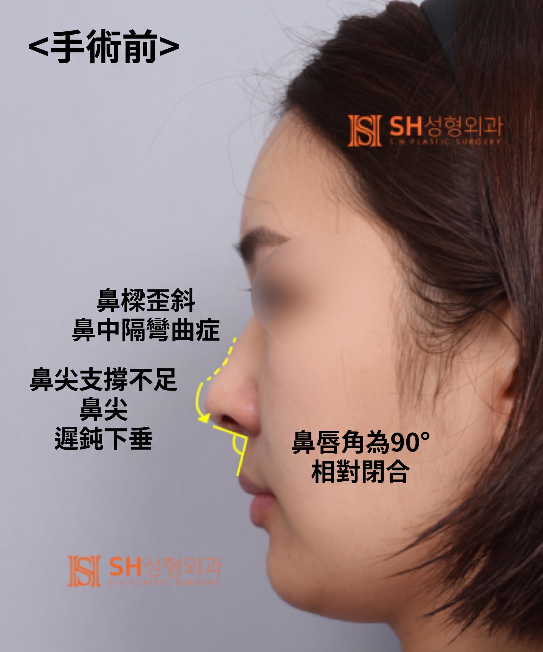 想縮鼻翼卻不適合?鼻尖才是關鍵的原因!SH整形外科 사진 9