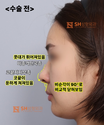 콧볼축소를 원하셨지만, 하면 안 됐던 코! 코끝이 먼저였던 이유 sh성형외과 에스에이치성형외과 사진 9