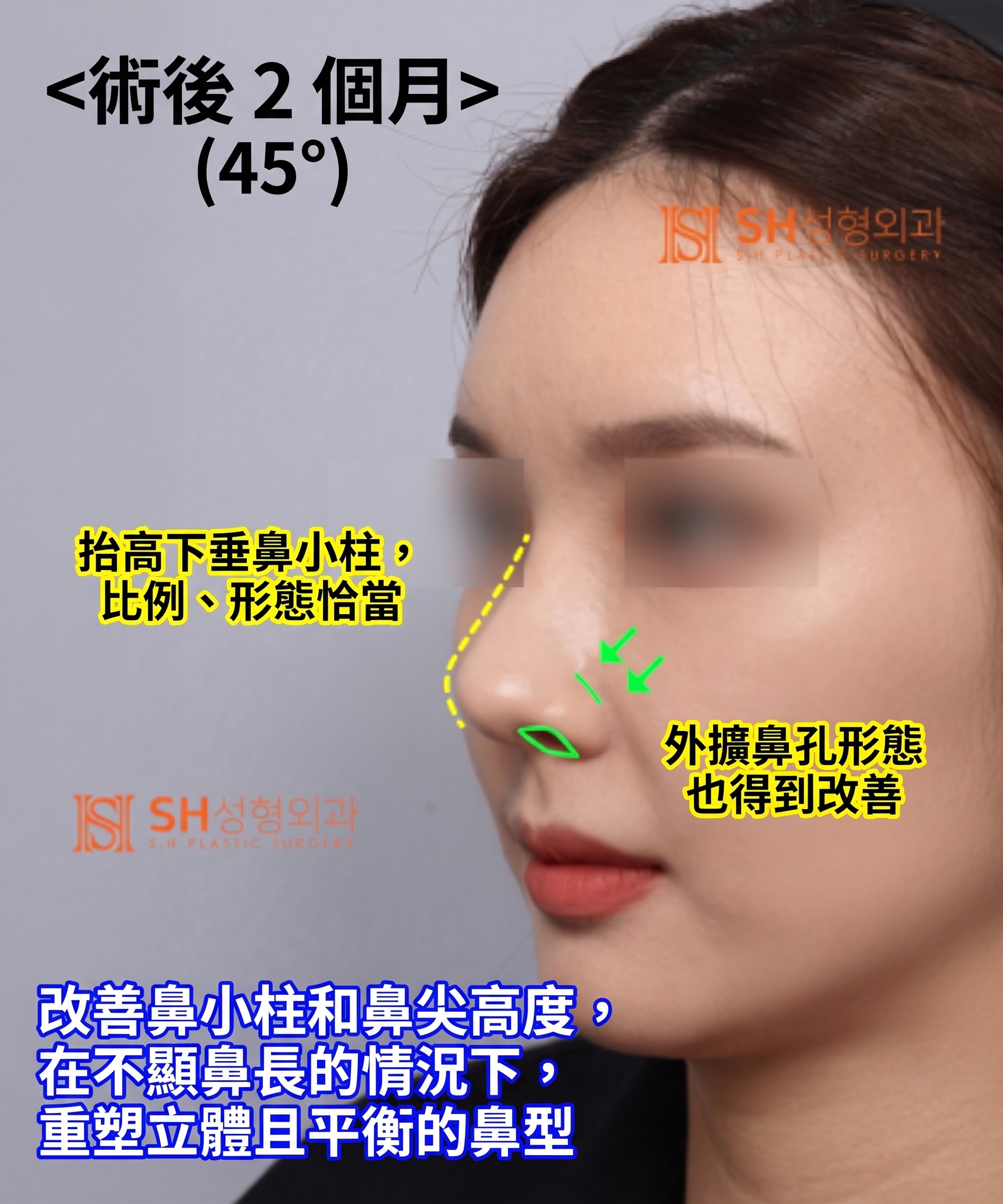 想縮鼻翼卻不適合?鼻尖才是關鍵的原因!SH整形外科 사진 21