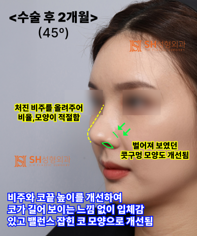 콧볼축소를 원하셨지만, 하면 안 됐던 코! 코끝이 먼저였던 이유 sh성형외과 에스에이치성형외과 사진 21