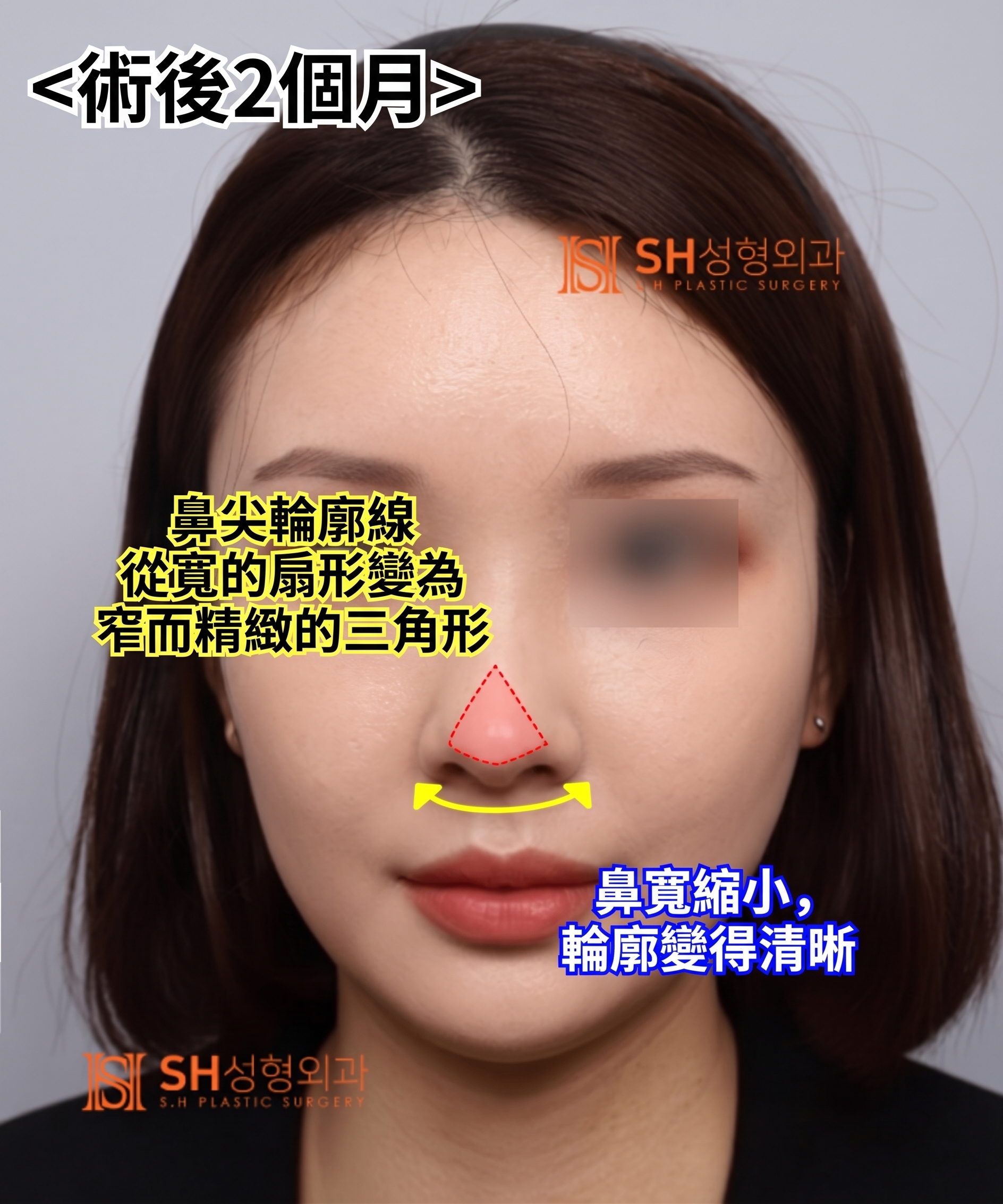 想縮鼻翼卻不適合?鼻尖才是關鍵的原因!SH整形外科 사진 13