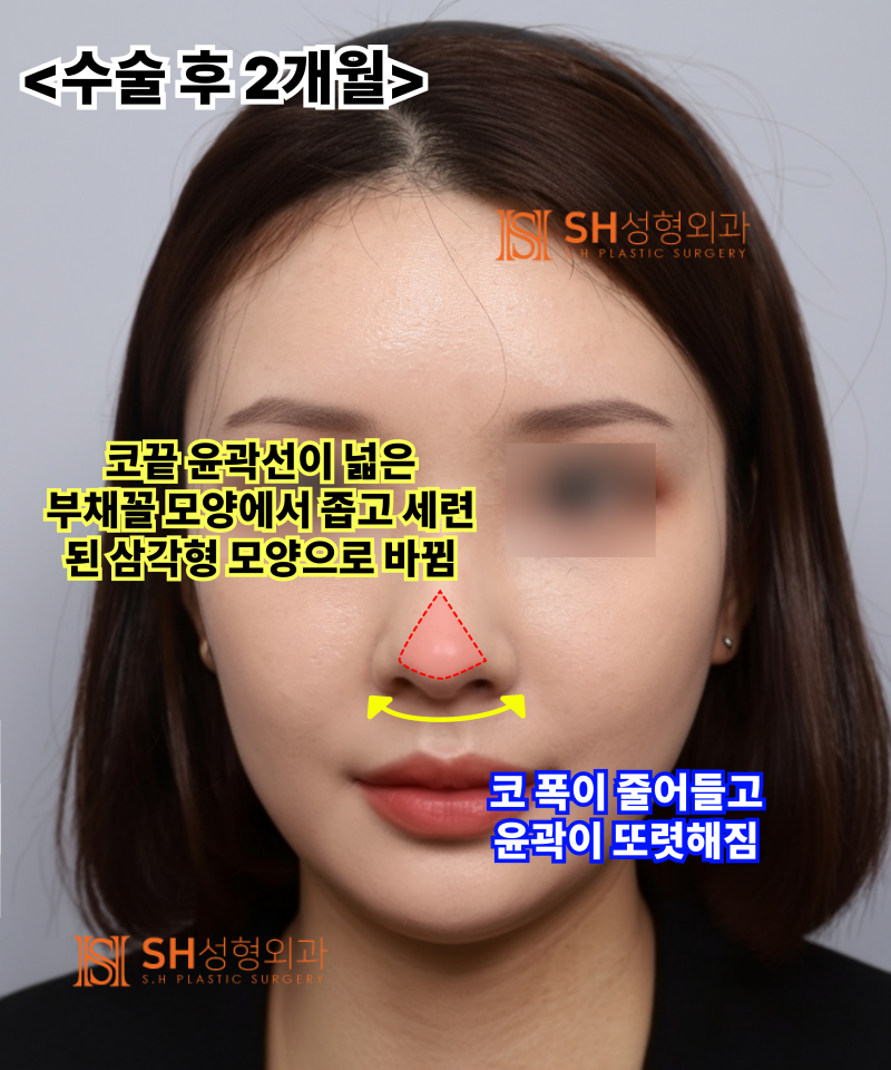 콧볼축소를 원하셨지만, 하면 안 됐던 코! 코끝이 먼저였던 이유 sh성형외과 에스에이치성형외과 사진 13