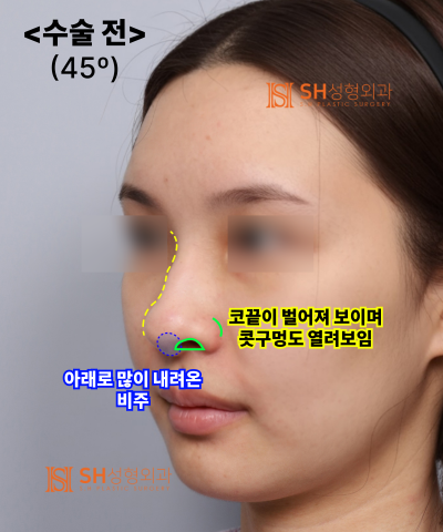 콧볼축소를 원하셨지만, 하면 안 됐던 코! 코끝이 먼저였던 이유 sh성형외과 에스에이치성형외과 사진 20