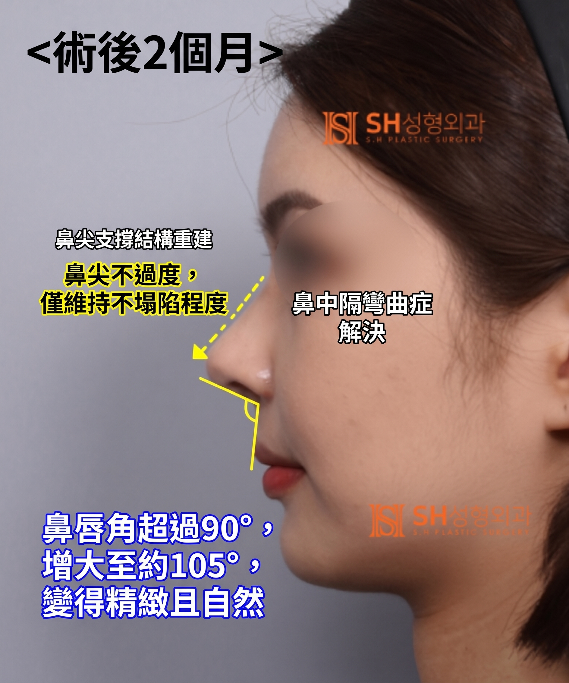 想縮鼻翼卻不適合?鼻尖才是關鍵的原因!SH整形外科 사진 19