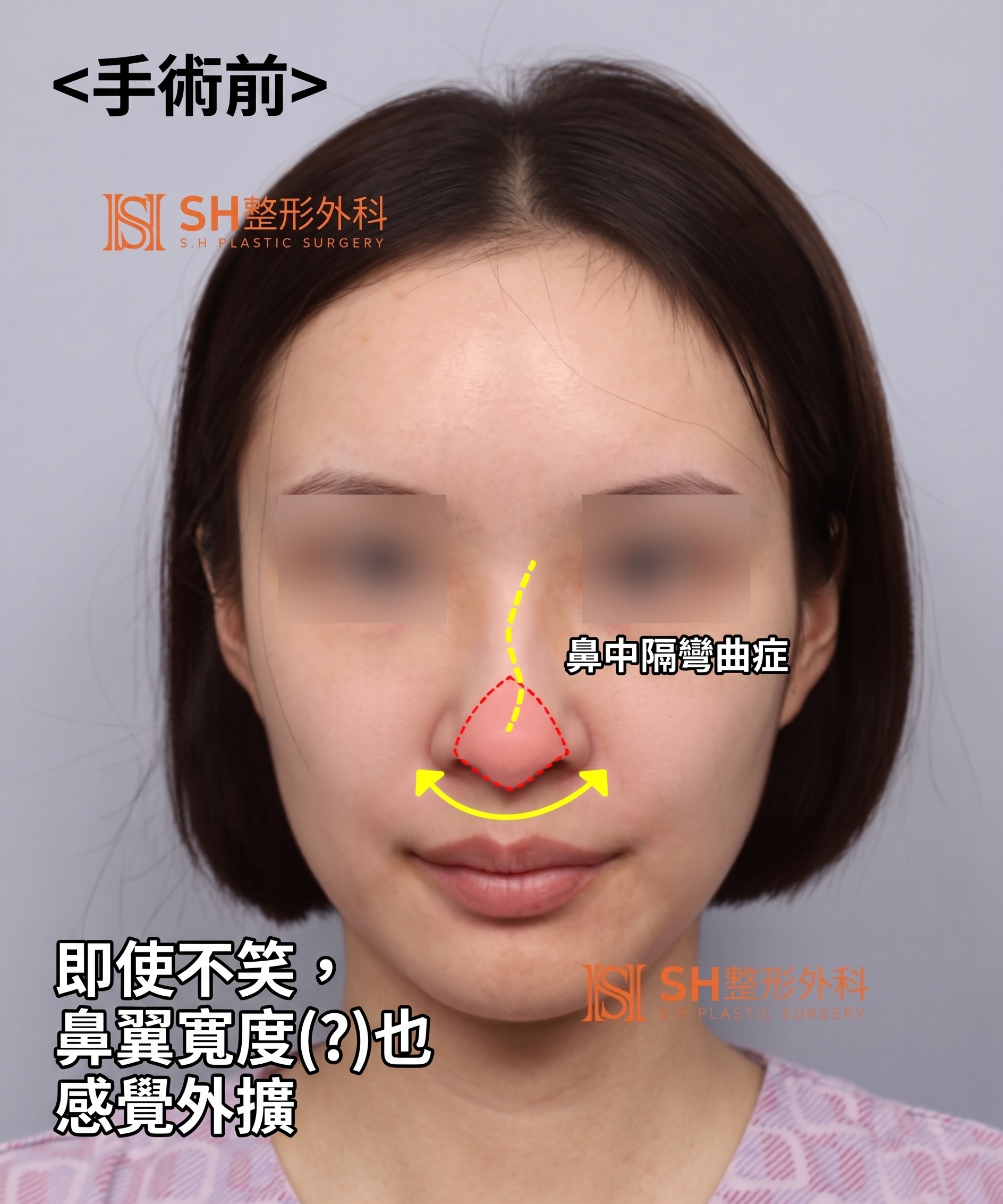 想縮鼻翼卻不適合?鼻尖才是關鍵的原因!SH整形外科 사진 22